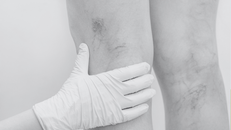 Vein Reduction(Small Area)
