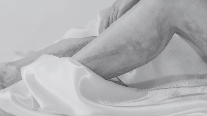Vein Reduction(Large Area)