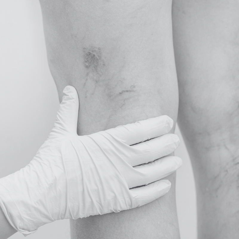 Vein Clarity Package (Small Area)