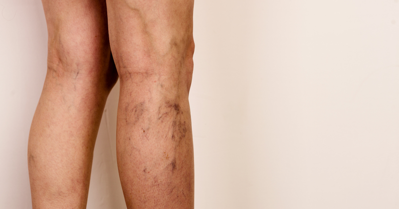 Vein Reduction